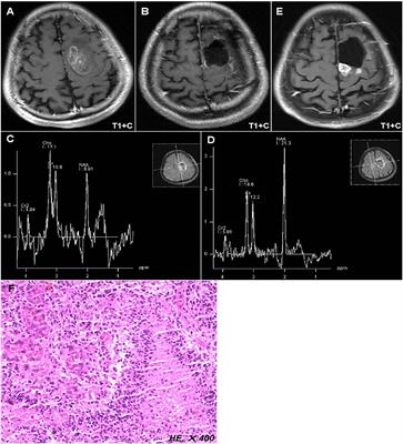 Higher Cho/NAA Ratio in Postoperative Peritumoral Edema Zone Is Associated With Earlier Recurrence of Glioblastoma